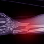 Broken Bones Accident Lawyers in Boise near me