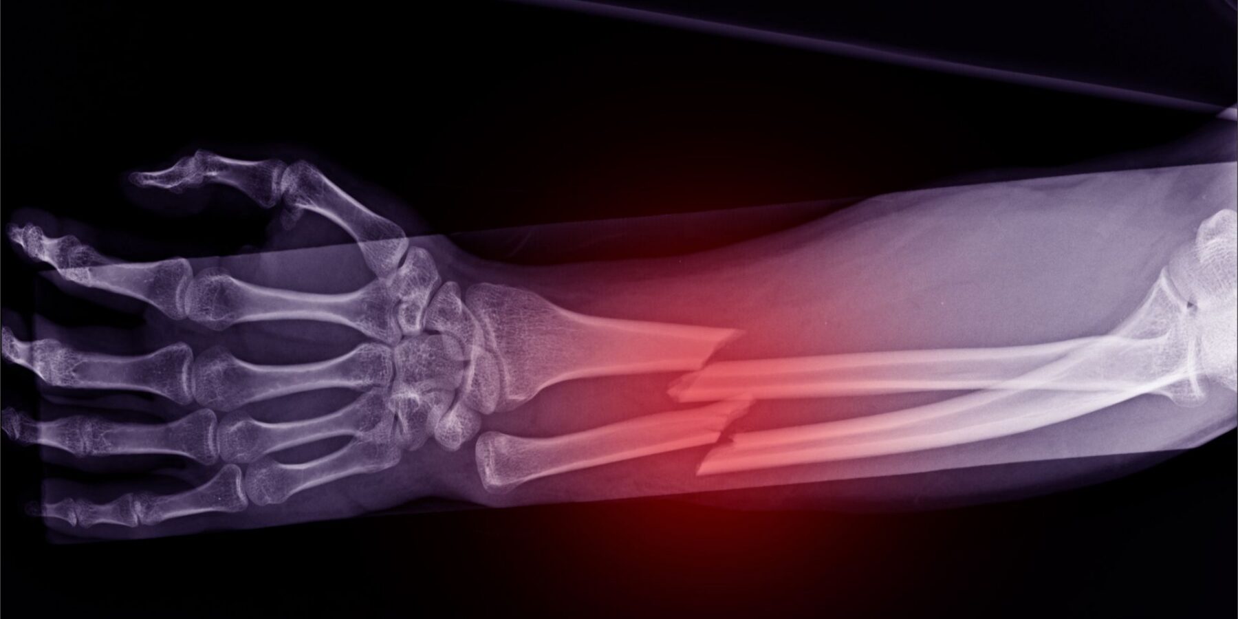 Broken Bones Accident Lawyers in Boise near me