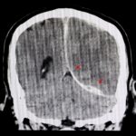 Traumatic Brain Injury Lawyers in Boise near me