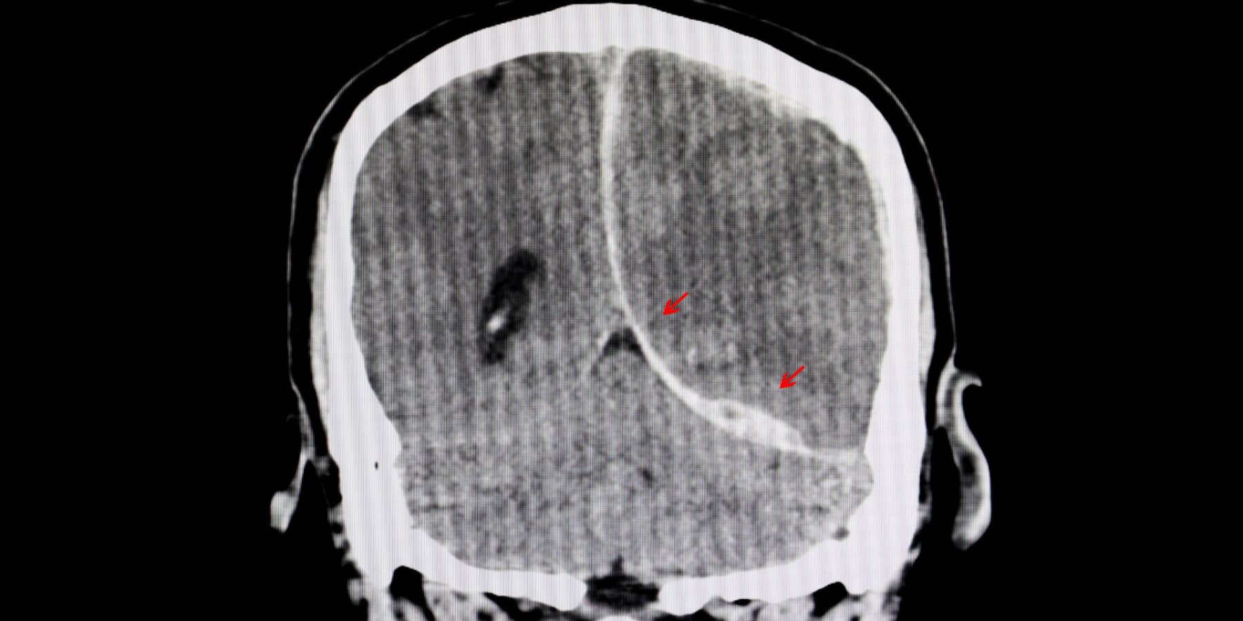 Traumatic Brain Injury Lawyers in Boise near me